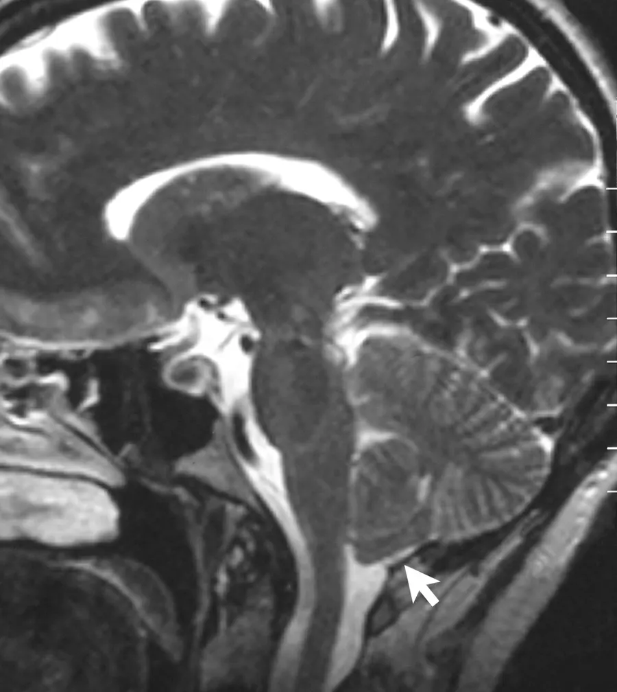 Sagittal MRI scan of the brain