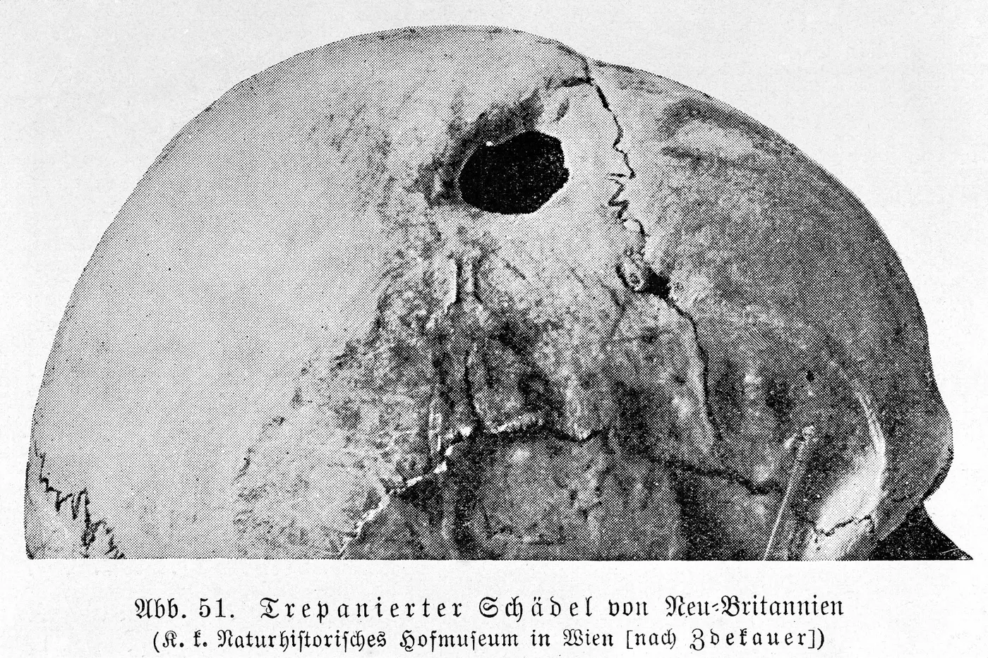 Historic photograph of a trepanned skull